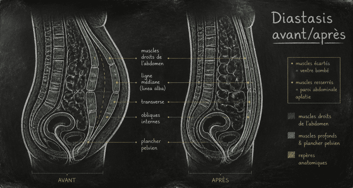 diastasis avant apres schema abdomen